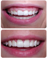 Dental Crown Lengthening