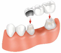 Dental Bridge