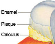 dental calculus