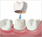 Dental Crown