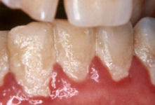 teeth with dental plaque