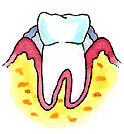 Mild Periodontitis