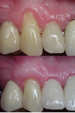 Gum Graft (Soft tissue graft)