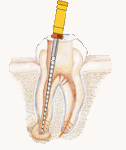 Root Canal Therapy